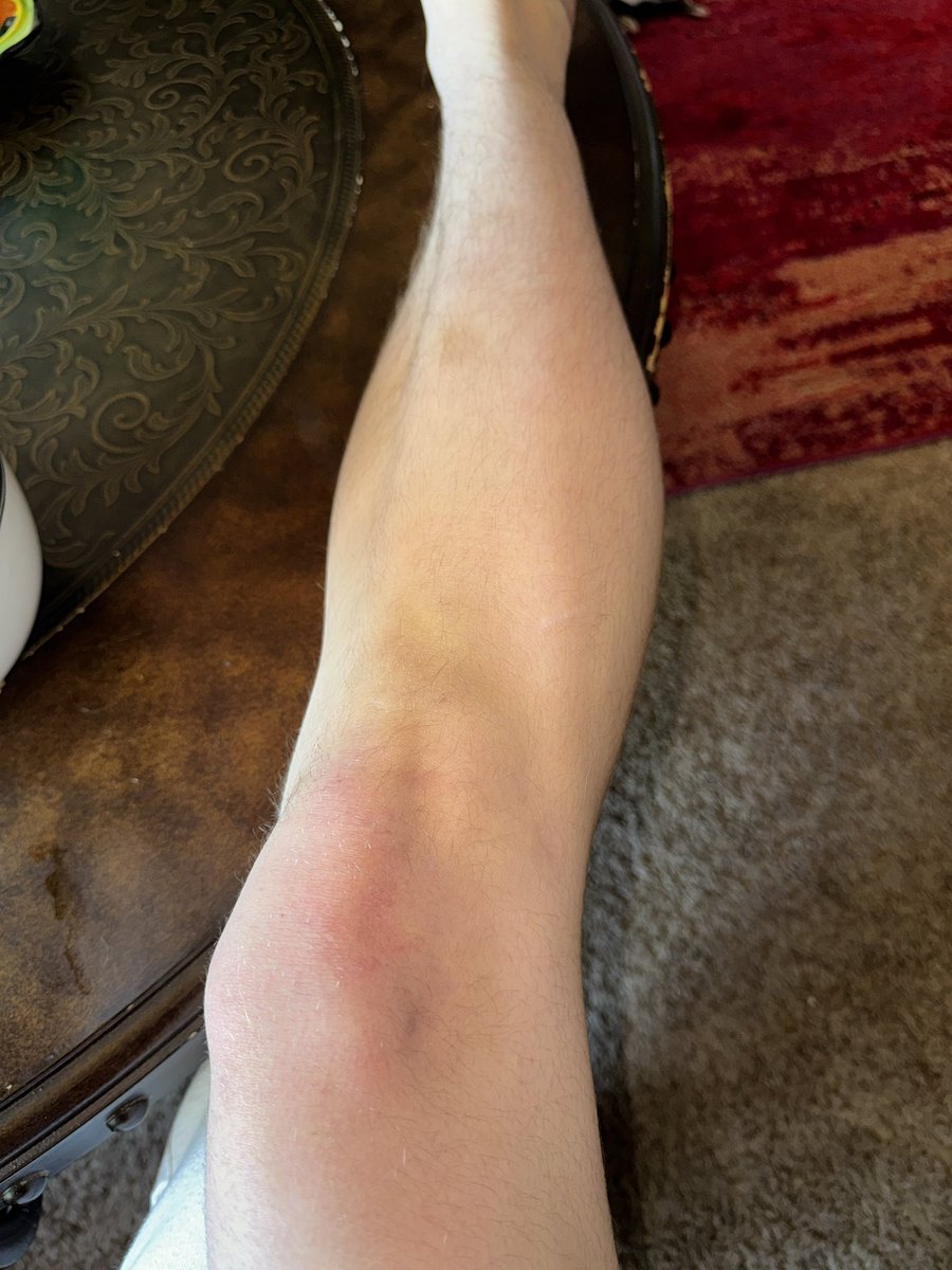 VicariousBliss's tweet photo. My fucker up foot and leg (the only sources of pain i can recall are that i dropped two bedframes on my foot and ankle, and my calves both hurt from a concert) https://t.co/KZT4Gw7p5c