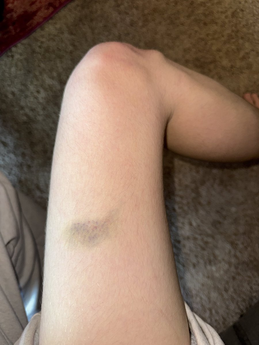 VicariousBliss's tweet photo. My fucker up foot and leg (the only sources of pain i can recall are that i dropped two bedframes on my foot and ankle, and my calves both hurt from a concert) https://t.co/KZT4Gw7p5c