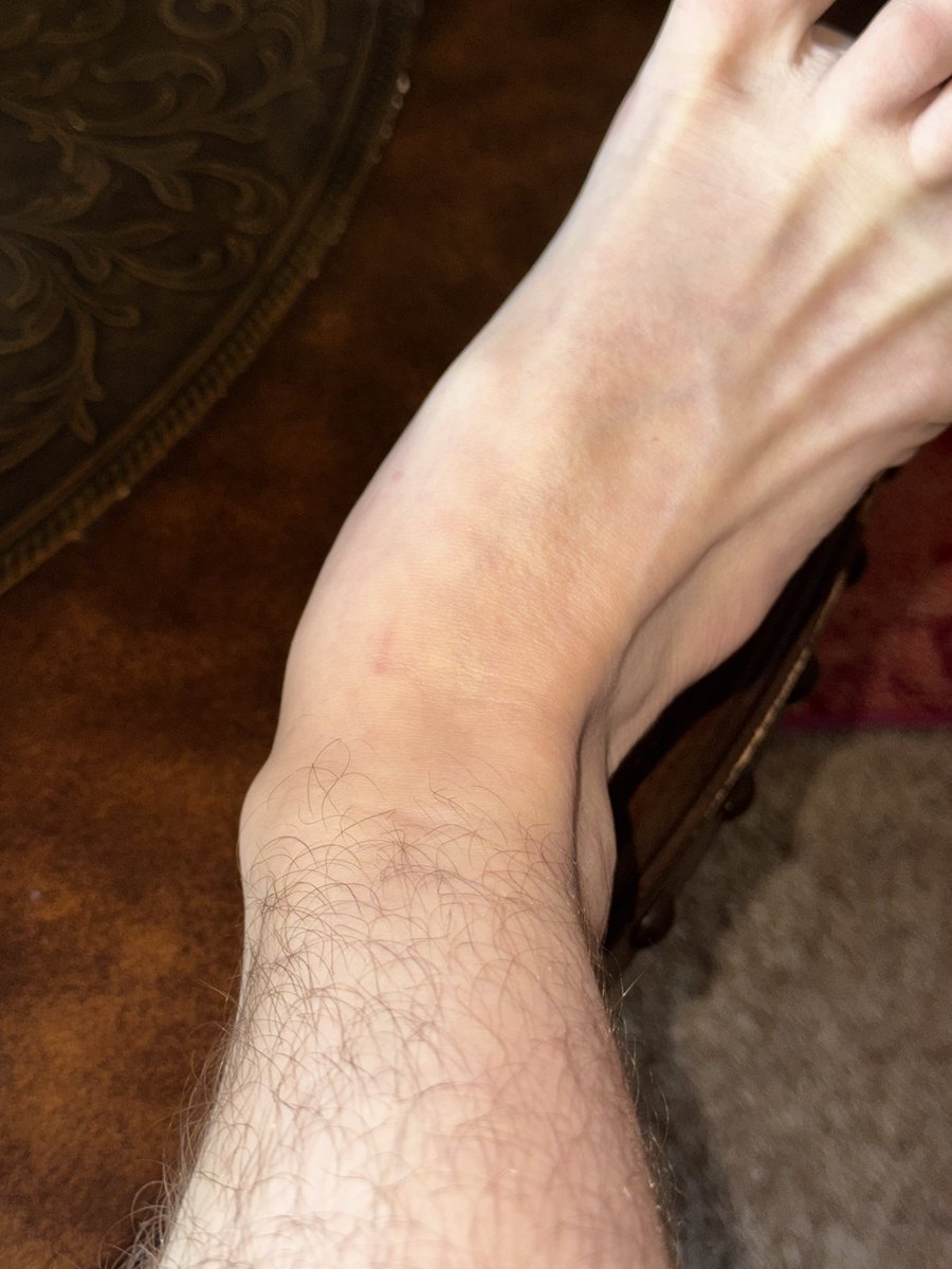 VicariousBliss's tweet photo. My fucker up foot and leg (the only sources of pain i can recall are that i dropped two bedframes on my foot and ankle, and my calves both hurt from a concert) https://t.co/KZT4Gw7p5c