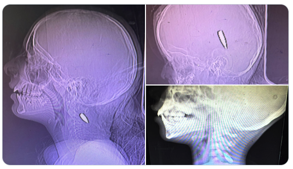 craigiskowitz's tweet photo. However, the point the original post was making was that almost any bullet fired from a military rifle that strikes someone in the head will cause tremendous damage, yet the x-rays that the NY Times published showed no such damage.

In fact, the skulls of the patients, many of whom were children, showed almost no damage at all, which is physically impossible if they were actually shot.

All the x-rays are fake. They simply placed a bullet underneath the child's head so it would appear in the x-ray.