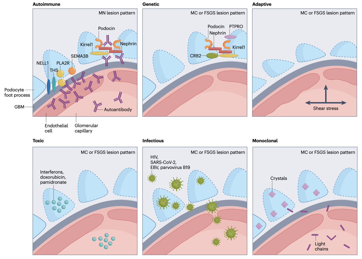 Nephro_Ivan's tweet photo. 😍 Excelente imagen de los diferentes mecanismos de daño en las podocitopatías!
🤓🤓👏🏻👏🏻👏🏻
👇🏻👇🏻
@DiseasePrimers https://t.co/mPIwBGo70f