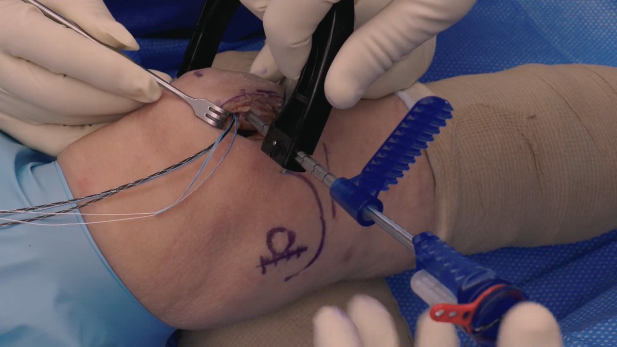 A medical procedure being performed on a patient's elbow or knee joint, with gloved hands using surgical instruments and sutures, marked with surgical pen lines on the skin.