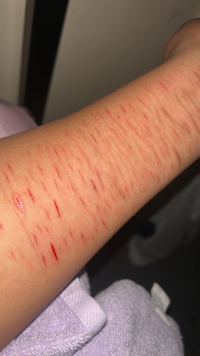 lexxi_blahh's tweet photo. Did some fake wound makeup 🤗 #sfxmakeup #fakeblood #slittwt #shtwt #relapsetwt #988twt https://t.co/xAu63qZpbM