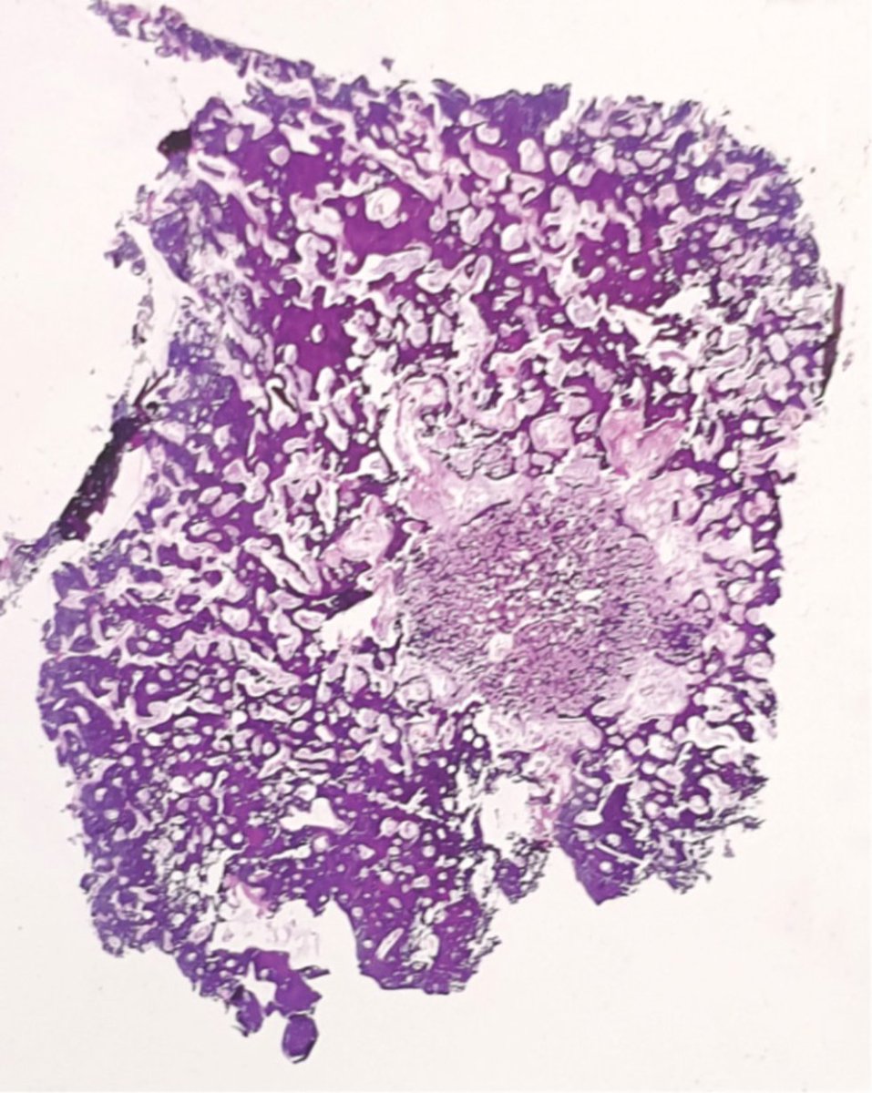 jppathpd's tweet photo. Dx? bone HE (This disease appeared in the Japanese Society of Pathology board certification examination. 2008-2b-18, 2001-1p-5). #Pathkeys https://t.co/K63FkSIxfb