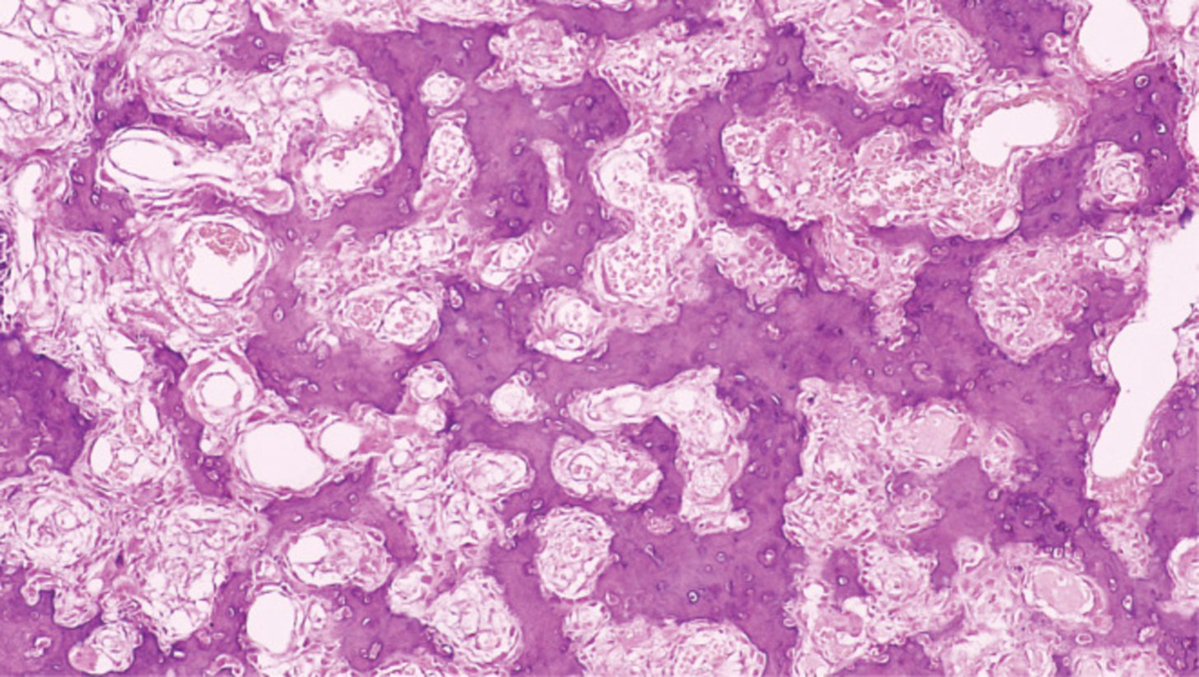 jppathpd's tweet photo. Dx? bone HE (This disease appeared in the Japanese Society of Pathology board certification examination. 2008-2b-18, 2001-1p-5). #Pathkeys https://t.co/K63FkSIxfb
