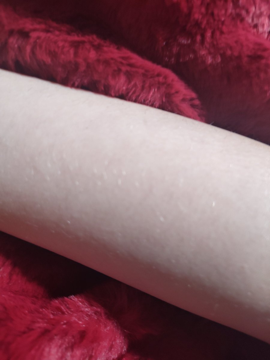 quirkless_hero1's tweet photo. #shedtwt Scar check 
<- left | right ->
(I'll never be #scarspo 😢) https://t.co/1PG3eS3GPS