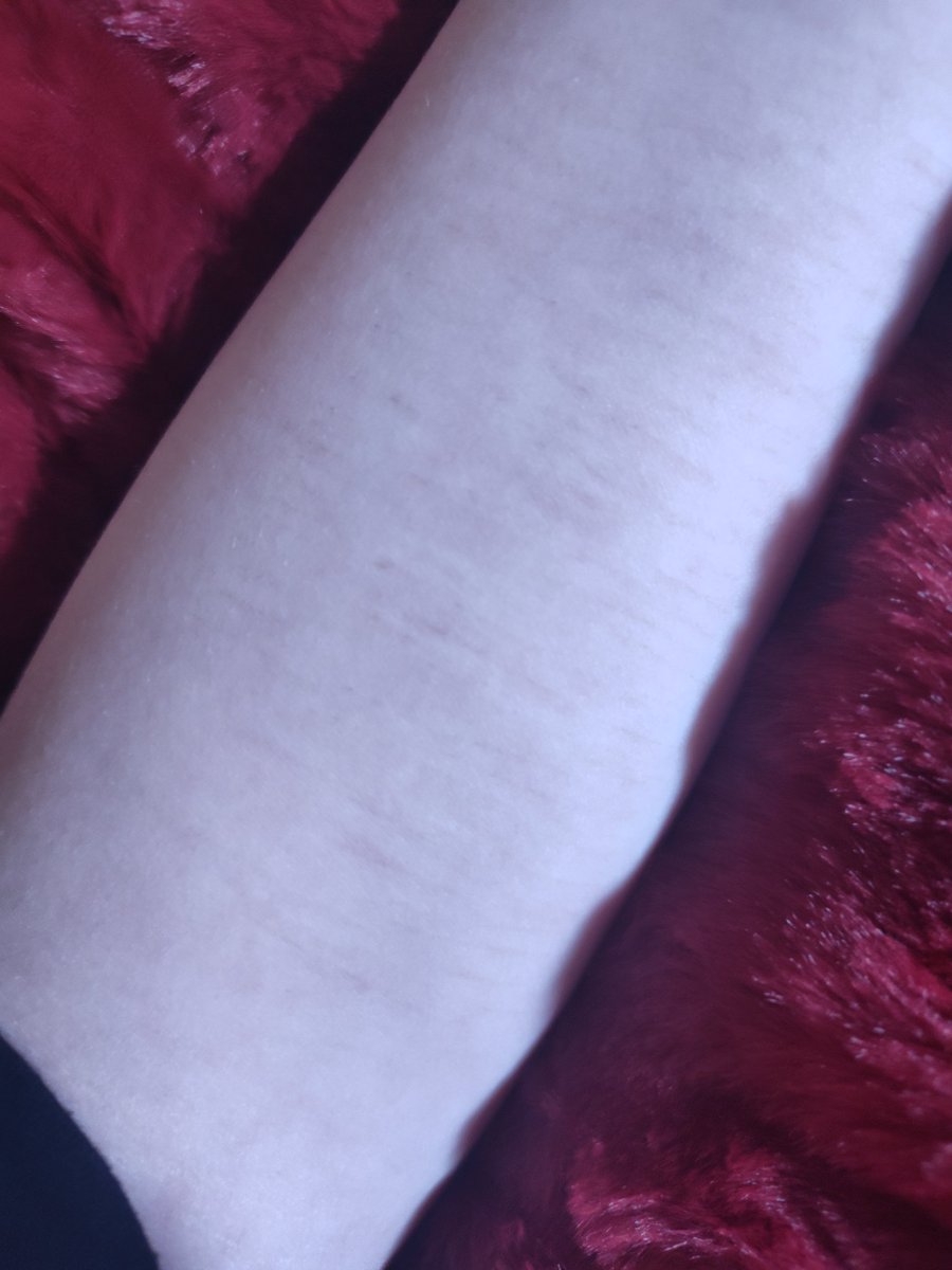 quirkless_hero1's tweet photo. #shedtwt Scar check 
<- left | right ->
(I'll never be #scarspo 😢) https://t.co/1PG3eS3GPS