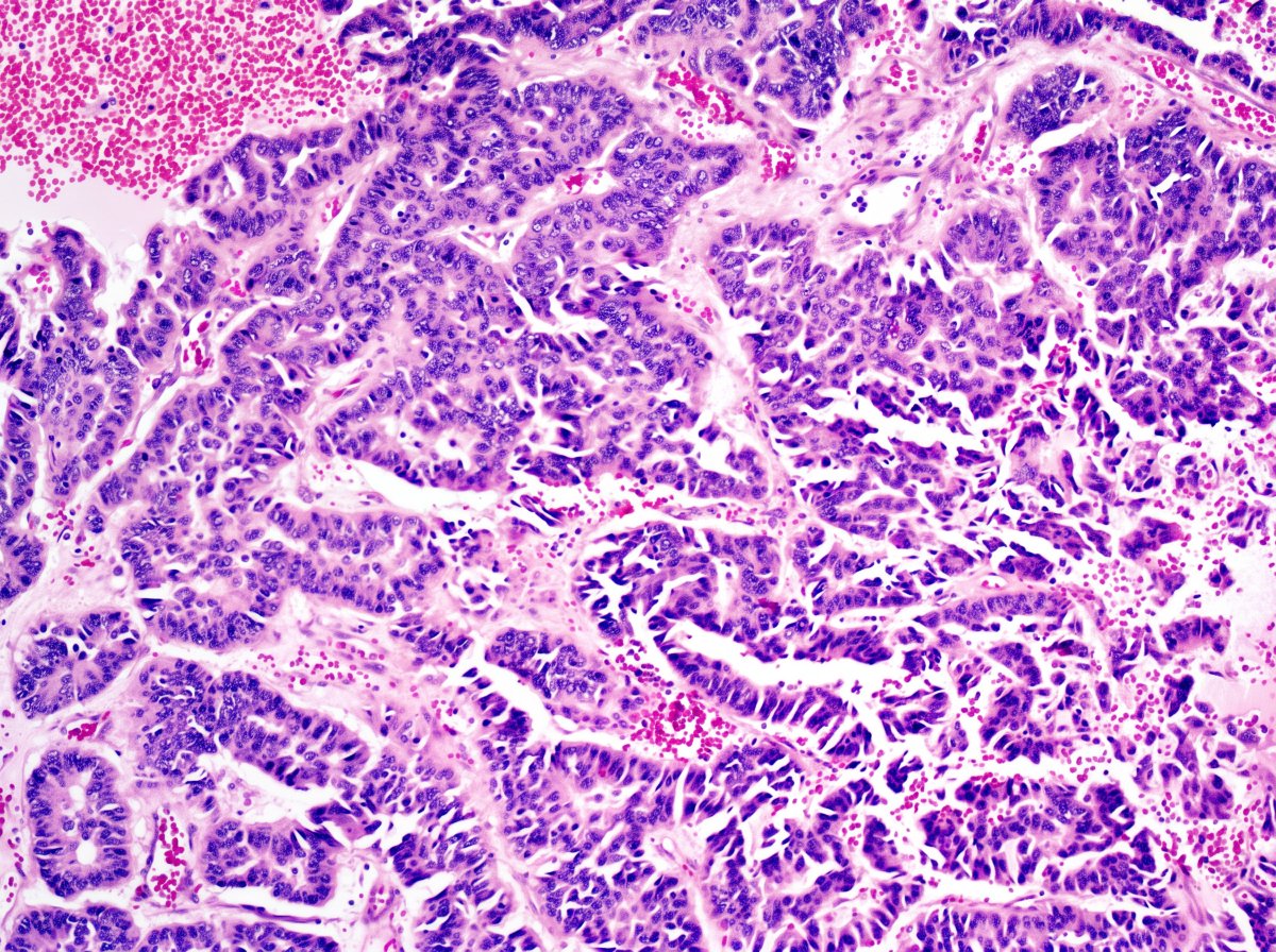 GuannanTiffany's tweet photo. 🧩 Kidney riddle
An unusual growth pattern for kidney tumor.
What kidney tumor would you consider for this bizarre architecture?
#DxMindMap #KidneyPath #GUPath #PathTwitter @JHUpath @MGBpathology https://t.co/GpDM2E8kvW