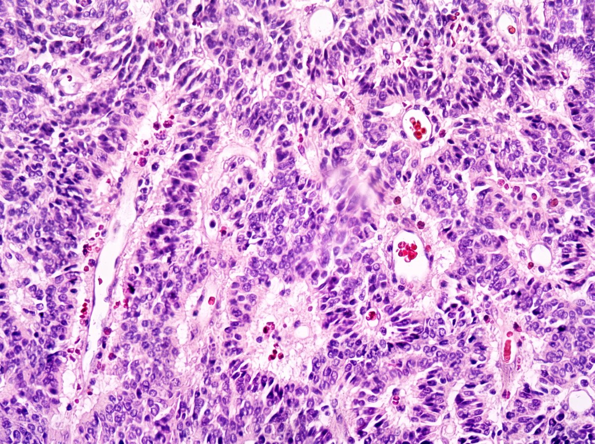 GuannanTiffany's tweet photo. 🧩 Kidney riddle
An unusual growth pattern for kidney tumor.
What kidney tumor would you consider for this bizarre architecture?
#DxMindMap #KidneyPath #GUPath #PathTwitter @JHUpath @MGBpathology https://t.co/GpDM2E8kvW