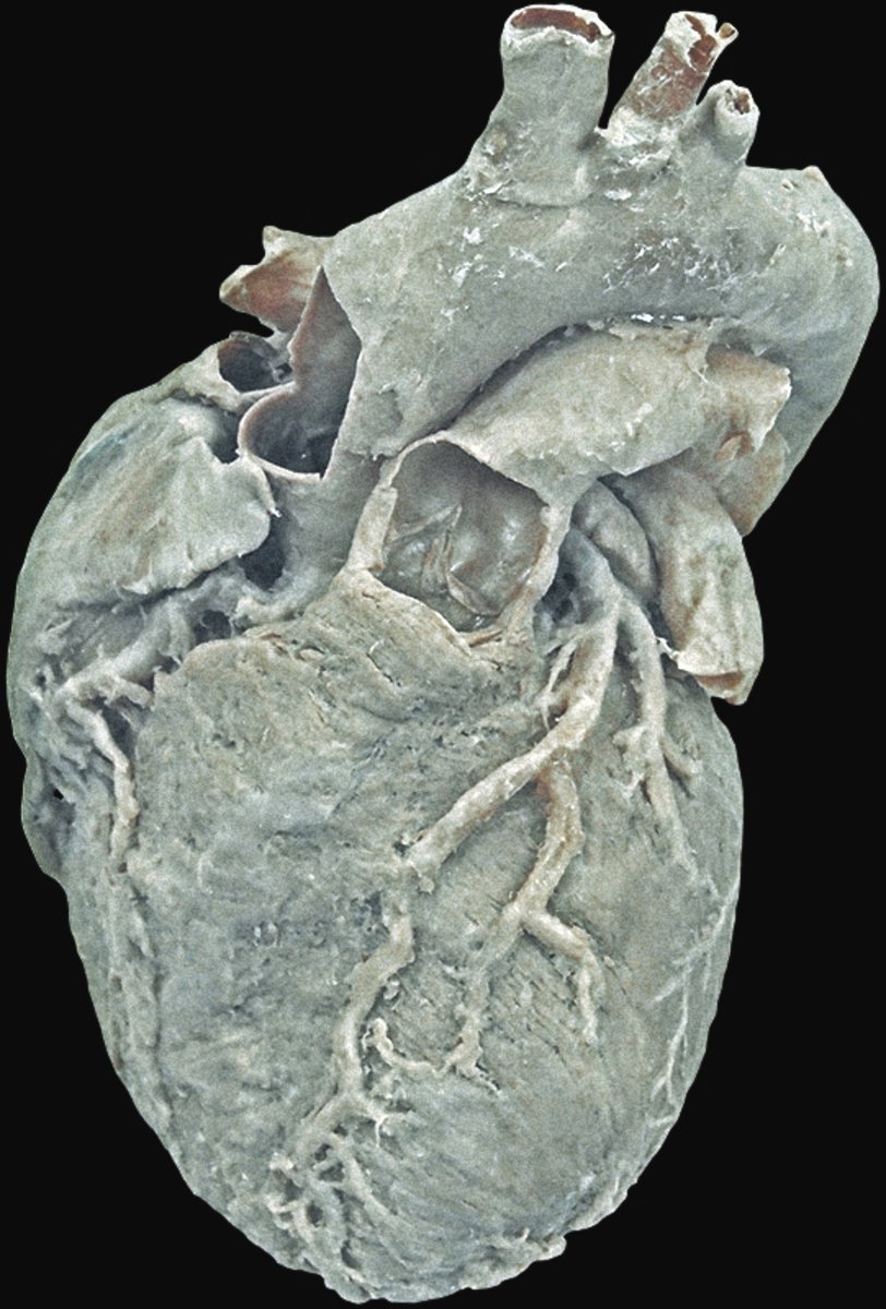 moriitician's tweet photo. anterior view of the heart. ⋆.ೃ࿔*:･ https://t.co/2UYMcco5G1