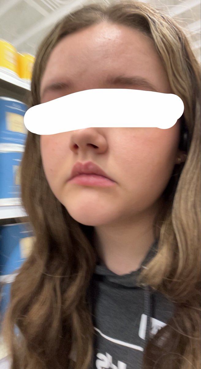 bruiisedbunnii's tweet photo. another hw vs now of my face

look disgusting in both but i need to remember why i can’t fucking binge anymore https://t.co/Jfv0A6yqnI