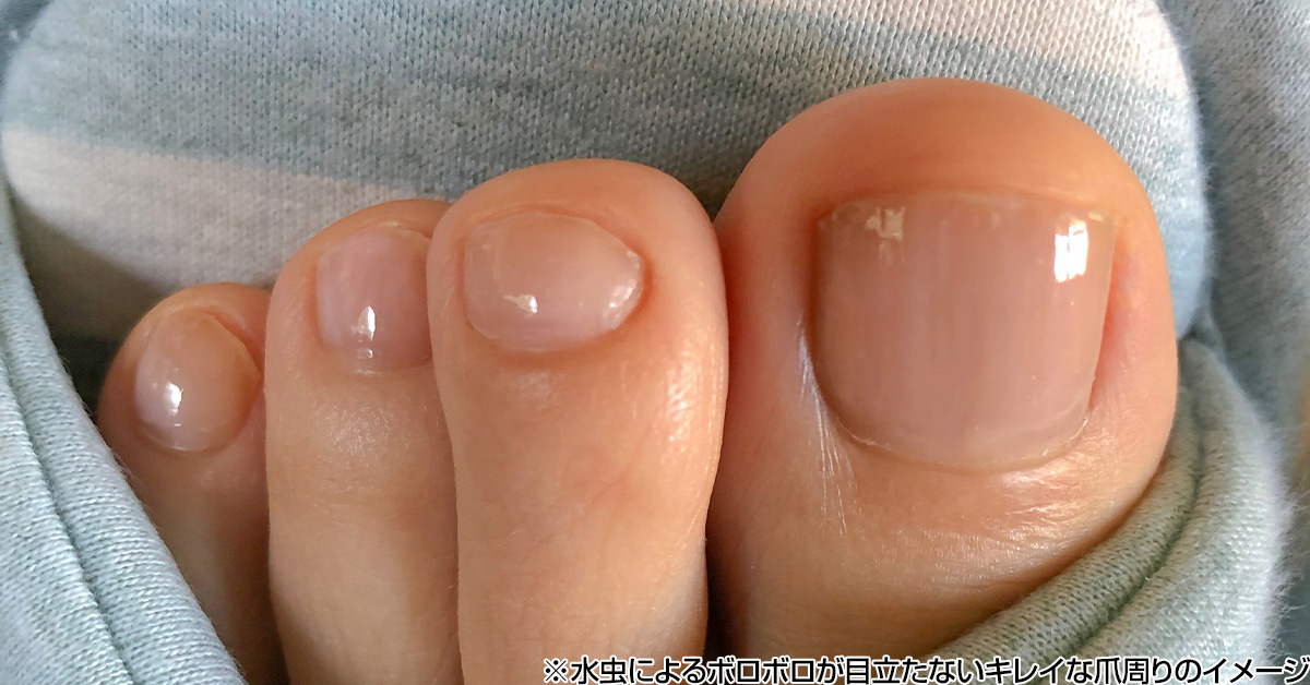 Kiyama_experts's tweet photo. たまげた！水虫治療薬がすごすぎ！爪まわりを根こそぎ殺菌できる救世主