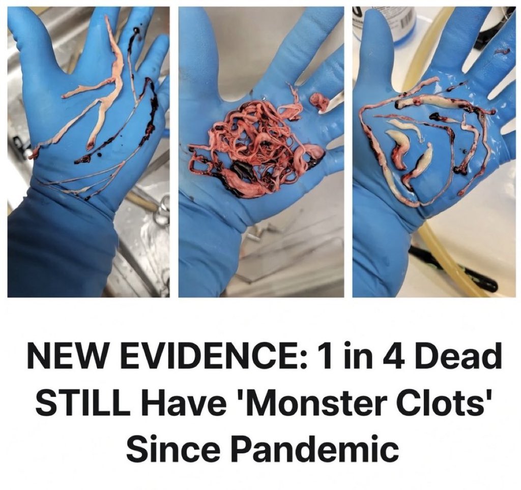 ValeriaAnne19's tweet photo. Retired USAF Major Tom Haviland has spent four years surveying embalmers across five countries.

66–83% of them are still finding these... white, rubbery, stretchy structures — sometimes over a foot long — that they say they never saw before 2021. https://t.co/XdDpTfaHud