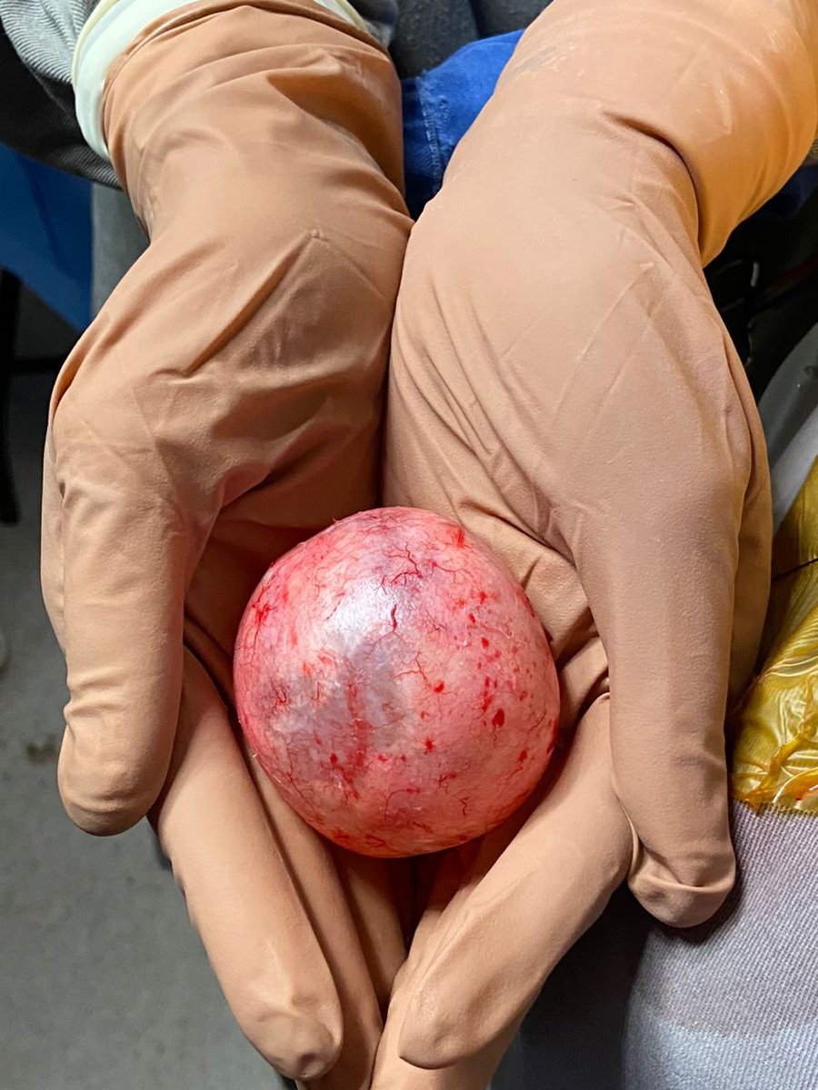LainaDavid123's tweet photo. Remarkable surgical case report: cranial epidermoid cyst in a pediatric patient 🧠
#MedicalStudent #Neurosurgery #PediatricSurgery #ClinicalCases #EpidermoidCyst #SurgicalExperience #Medicine #PediatricNeurosurgery https://t.co/CLPu5IR9fV
