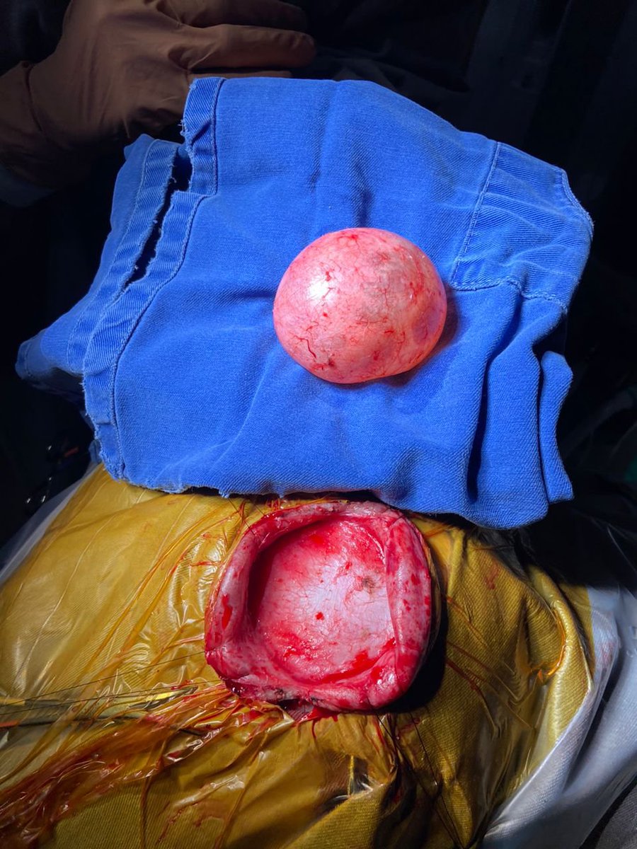 LainaDavid123's tweet photo. Remarkable surgical case report: cranial epidermoid cyst in a pediatric patient 🧠
#MedicalStudent #Neurosurgery #PediatricSurgery #ClinicalCases #EpidermoidCyst #SurgicalExperience #Medicine #PediatricNeurosurgery https://t.co/CLPu5IR9fV