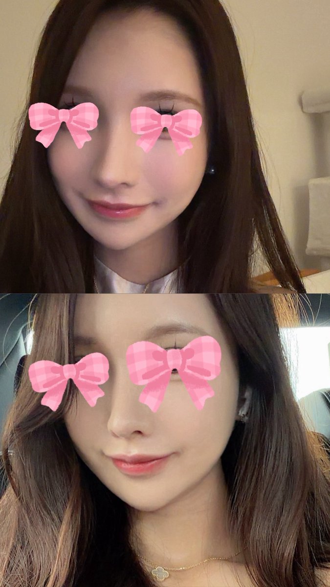 骨切りしてから輪郭のメンテでオンダリフト定期的にやってるんだけど、やっぱり好き🥹🎀

体重ほぼ変わってないのに、個人的に頬〜フェイスラインのもたつきがすっきり見えて顔の余白減った感じする。こういう「何したか分からないけどなんか盛れてる」系の変化が一番嬉しい…

今回は韓国のSIA CLINICで受けてきた🇰🇷🤍

@siaclinic_jp
#PR #シアクリニック #SIACLINIC #韓国美容 #美容皮膚科 #韓国皮膚科 #オンダリフト