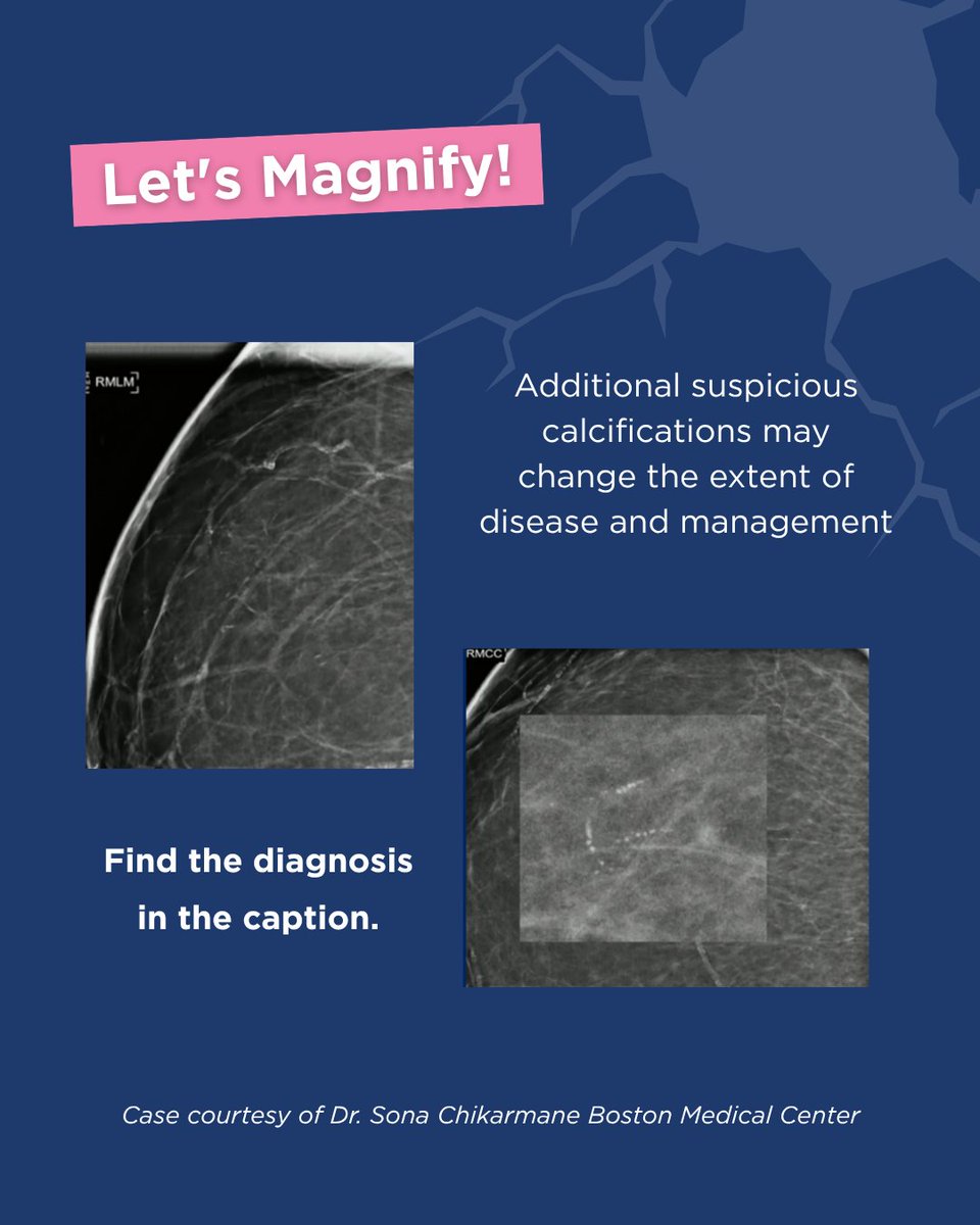 BreastImaging's tweet photo. Did you crack this month's case? Let us know if you spotted the same additional suspicious areas!
What is the diagnosis?
- Initial mass- grade 3 IDC
- Additional calcifications- high grade DCIS
#CracktheCase #BreastRadiology #Mammography #BIRADS #BreastCalcifications https://t.co/Uo6C9kuNAd