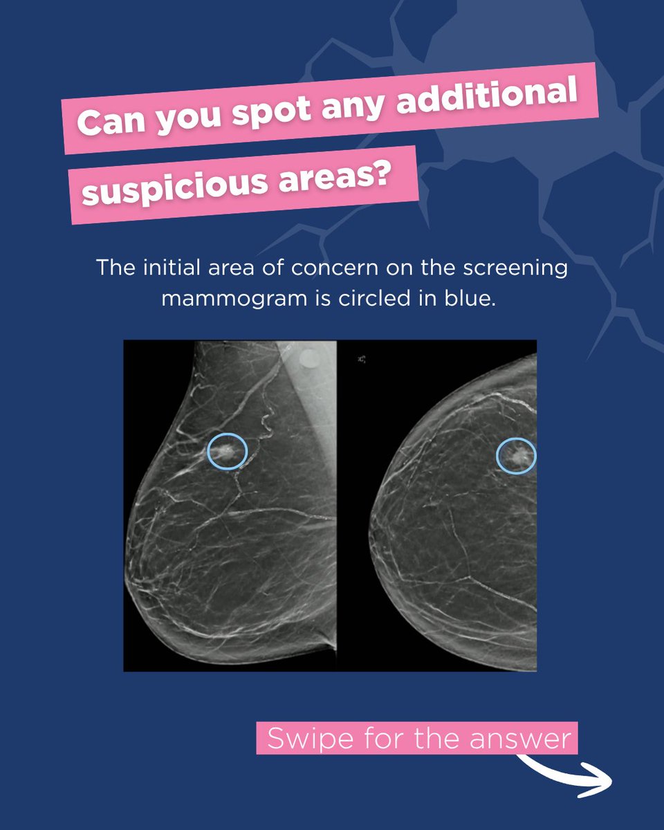 BreastImaging's tweet photo. Did you crack this month's case? Let us know if you spotted the same additional suspicious areas!
What is the diagnosis?
- Initial mass- grade 3 IDC
- Additional calcifications- high grade DCIS
#CracktheCase #BreastRadiology #Mammography #BIRADS #BreastCalcifications https://t.co/Uo6C9kuNAd