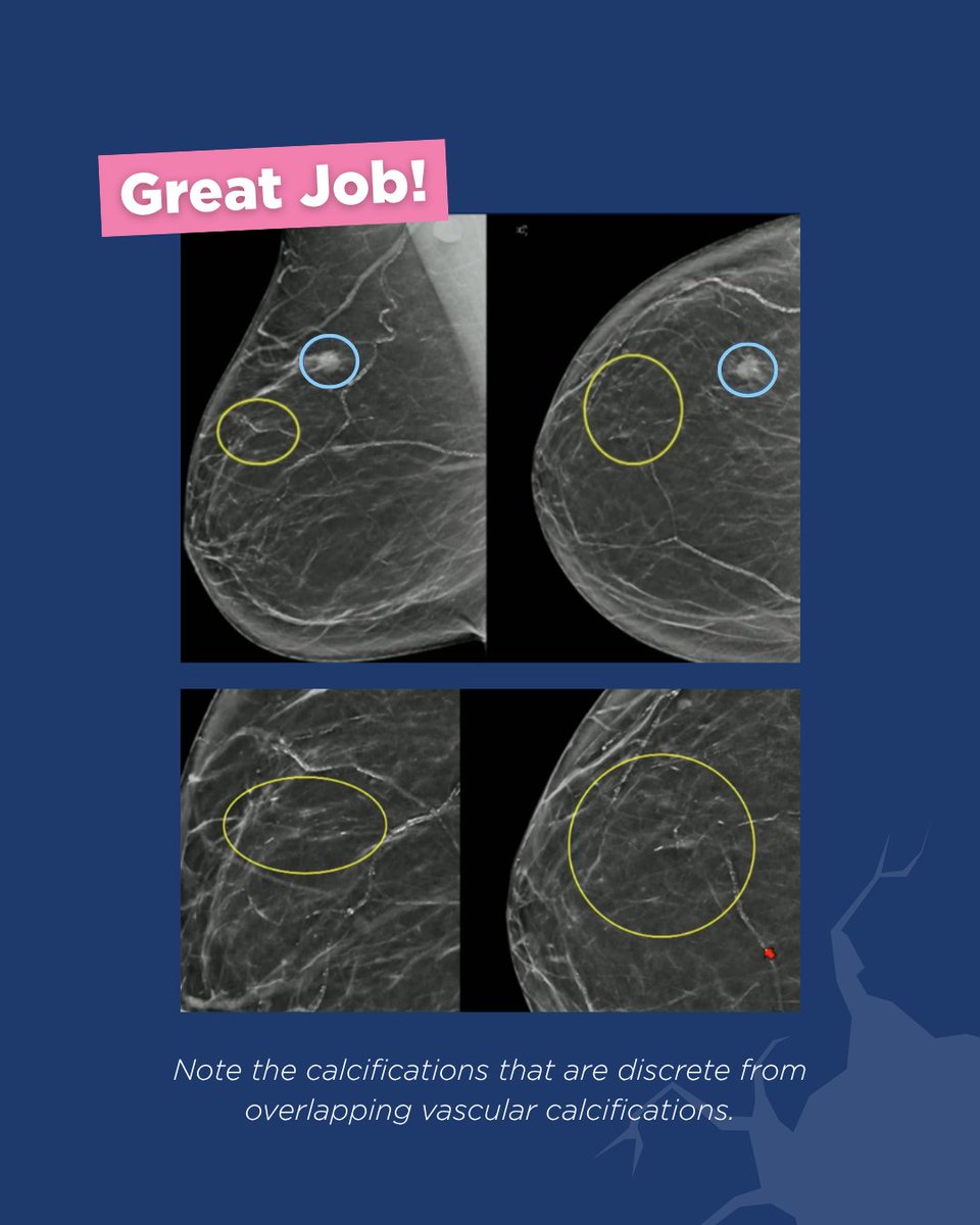 BreastImaging's tweet photo. Did you crack this month's case? Let us know if you spotted the same additional suspicious areas!
What is the diagnosis?
- Initial mass- grade 3 IDC
- Additional calcifications- high grade DCIS
#CracktheCase #BreastRadiology #Mammography #BIRADS #BreastCalcifications https://t.co/Uo6C9kuNAd
