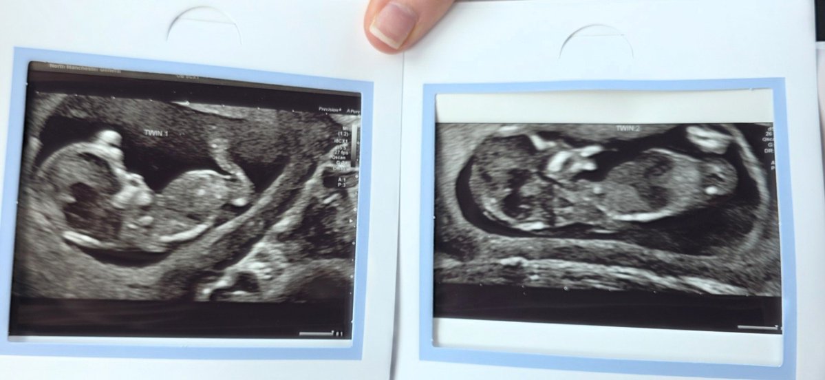 MichaelJPerry94's tweet photo. Two little babies due this Dec, but the reality of winter bills and needing double the gear has left us in a really tough spot. No donations yet, but we are staying hopeful. Even a quick RT!

Please click the link 
https://t.co/yGXy6ow8RL

#MutualAidUK #TwinPregnancy #GoFundMe https://t.co/gfuIwcKXuW