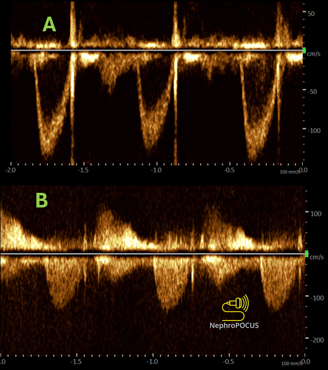 NephroP's tweet photo. #POCUS Doppler quiz 👇 
#Nephpearls #MedEd 

Tracings A and B were obtained from the same person in the apical 5-chamber view, with the Doppler line in the LVOT.
Which is correct (most likely; assuming the view is optimal)?
A. A = PW Doppler; B = CW Doppler
B. A = CW Doppler; B = PW Doppler
C. Both are PW Doppler
D. Both are CW Doppler
And why? 🤔