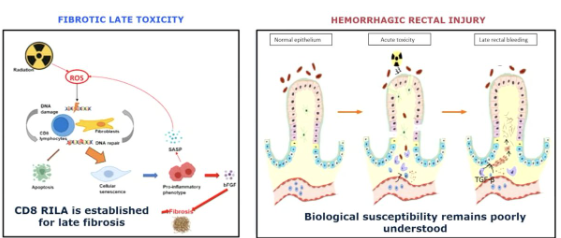 urotoday's tweet photo. Functional radiosensitivity assay identifies immune markers associated with late rectal bleeding after prostate radiotherapy: The #TransPROUST study. Presentation by @DebbiKamel. #ASTRO26 written coverage by @zklaassen_md > https://t.co/giS3Vw11rT @ASTRO_org https://t.co/8WzVqJ6SPP