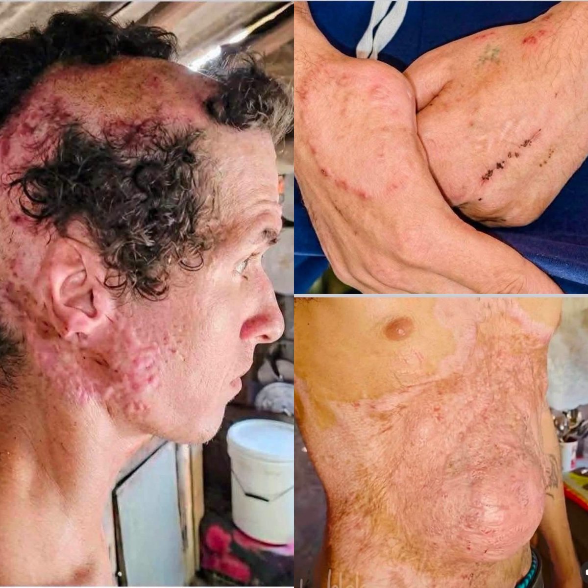 Cubaestadofalli's tweet photo. Joven cubano VÍCTIMA DE EL SERVICIO MILITAR OBLIGATORIO EN CUBA! Discapacitado y ABANDONADO!!! https://t.co/ih3Pdux0gH