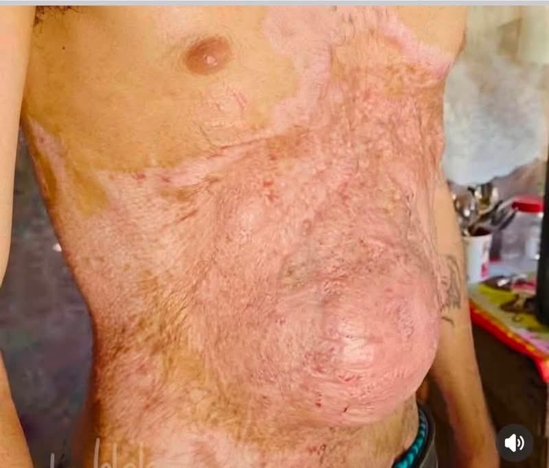 Cubaestadofalli's tweet photo. Joven cubano VÍCTIMA DE EL SERVICIO MILITAR OBLIGATORIO EN CUBA! Discapacitado y ABANDONADO!!! https://t.co/ih3Pdux0gH