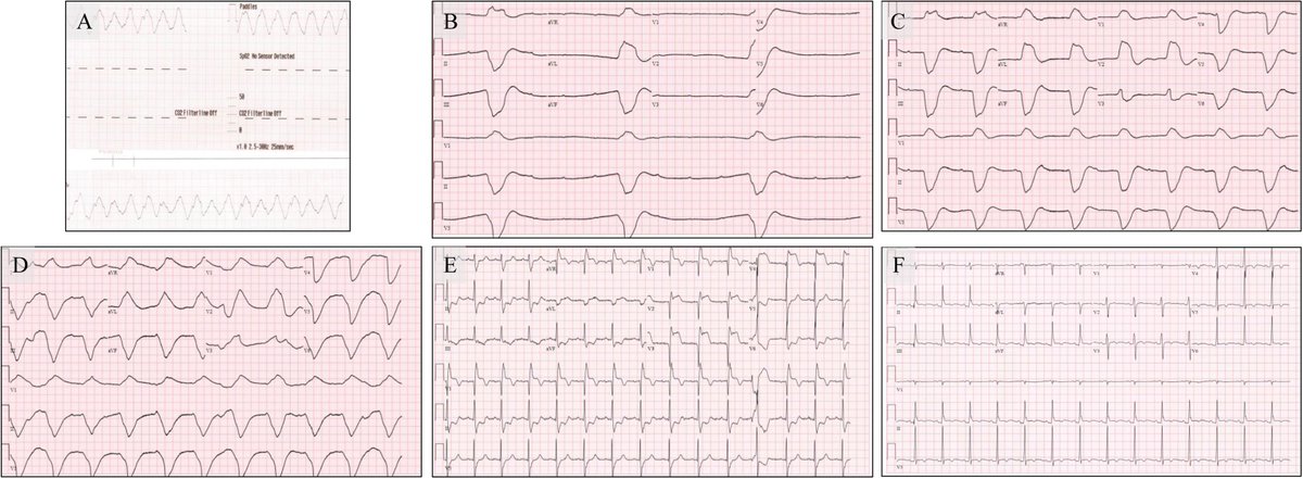 HRS_CaseReports's tweet photo. A Shark Fin Heart - A Case of Fulminant Myocarditis 
https://t.co/ljQcTvFEus https://t.co/DpeCvNT0uM