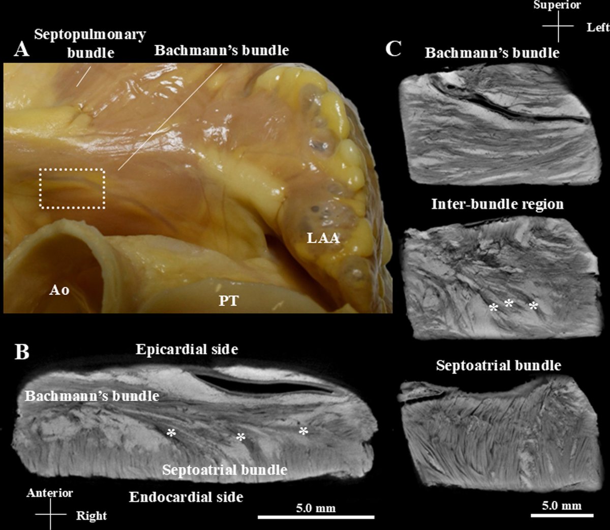 HRS_CaseReports's tweet photo. Residual Conduction across the Supero-Septal Ablation Line during Mitral-Isthmus Dependent Atrial Flutter 
https://t.co/KX9SWzY5bZ https://t.co/VKuCUWZg87
