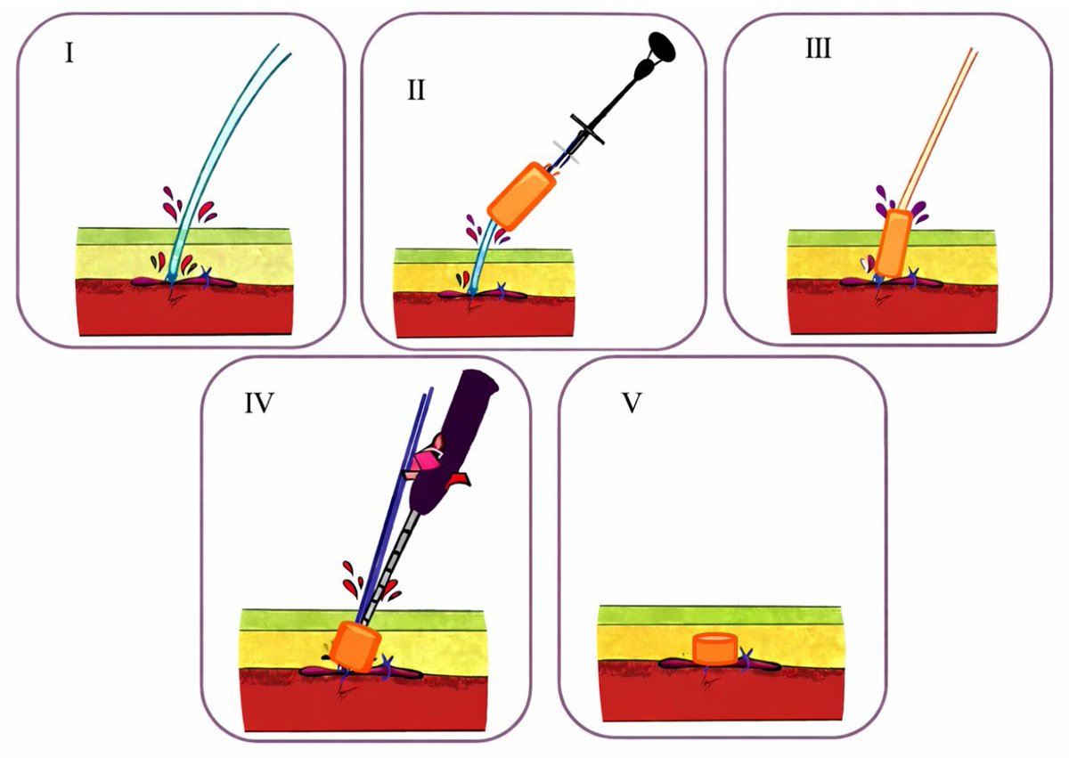 InvasiveCardiol's tweet photo. 🆕~Just Published~🆕

SAFE-SEAL: A Bail-Out Technique for Percutaneous Femoral Closure After Failed Hybrid Closure

Read it now in Early View 👉
https://t.co/HYYDQQMhdl

@DLBHATTMD #cardioTwitter #cardioX #cardiology #interventionalcardiology https://t.co/L2KJ7KNWwi