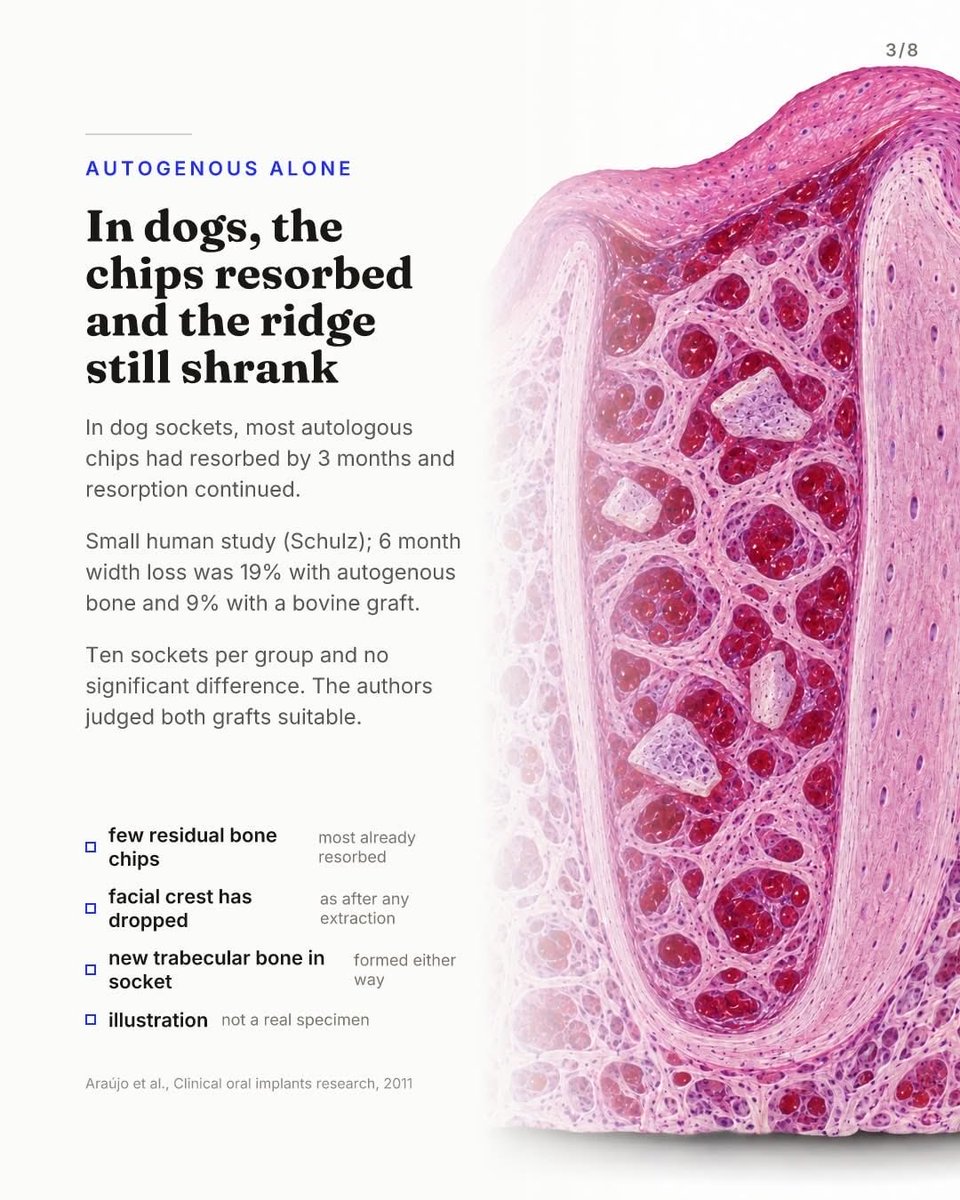 drAnasabdo's tweet photo. •Autogenous bone earns its reputation in ridge augmentation. Inside a fresh extraction socket, that reputation is mostly untested.
•الطعم الذاتي في الحفاظ على جوف القلع.
Courtesy:Advanced implantology work group

#endo_prostho_ortho
#EPO
#DrABDO
•You can ask …!!

•follow me: https://t.co/VLa3xRfhT5