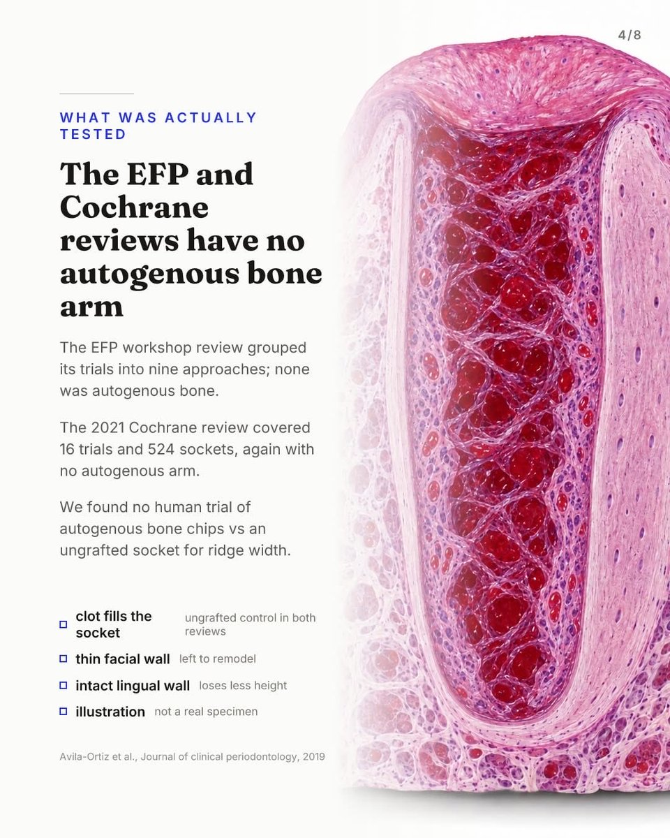 drAnasabdo's tweet photo. •Autogenous bone earns its reputation in ridge augmentation. Inside a fresh extraction socket, that reputation is mostly untested.
•الطعم الذاتي في الحفاظ على جوف القلع.
Courtesy:Advanced implantology work group

#endo_prostho_ortho
#EPO
#DrABDO
•You can ask …!!

•follow me: https://t.co/VLa3xRfhT5