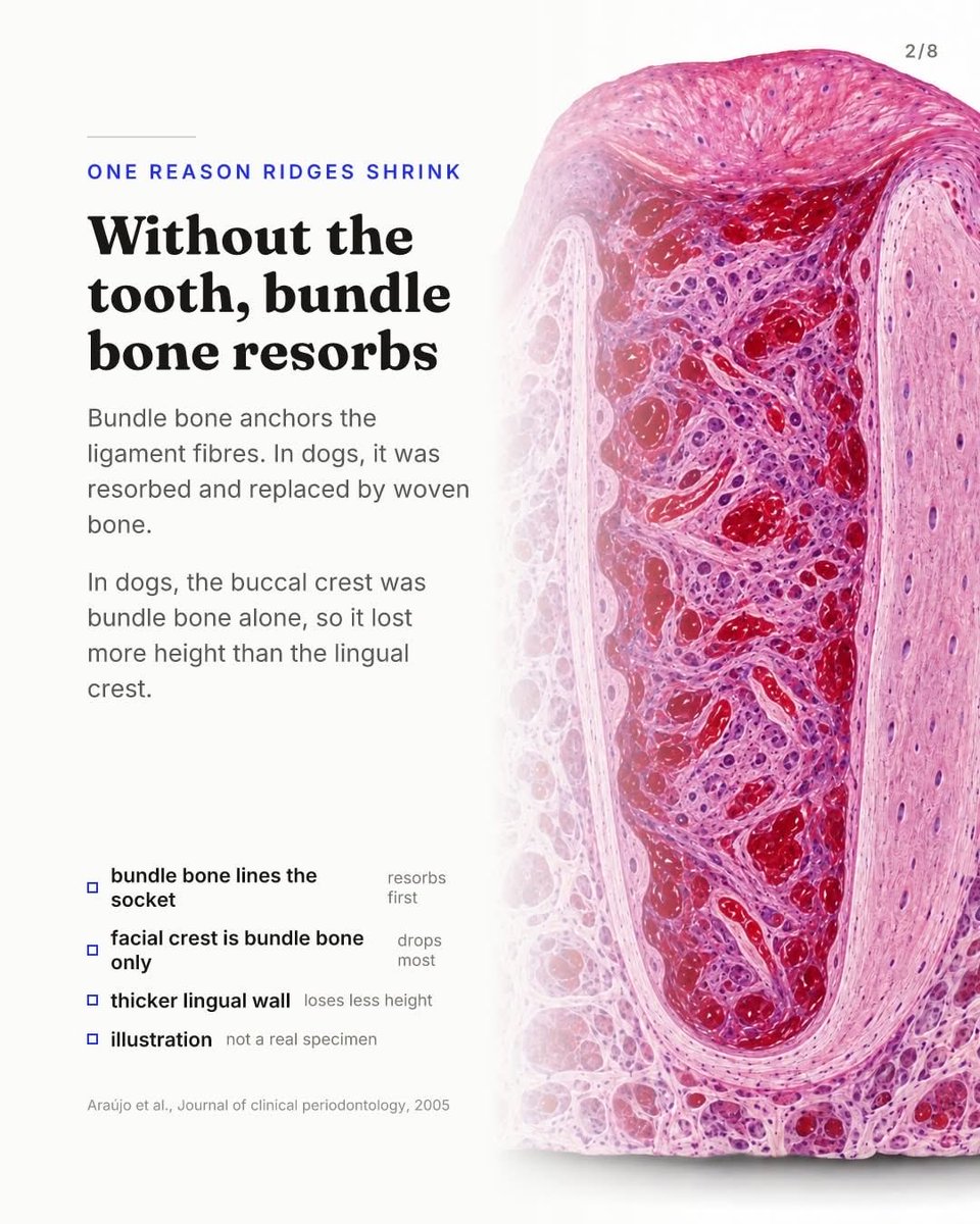 drAnasabdo's tweet photo. •Autogenous bone earns its reputation in ridge augmentation. Inside a fresh extraction socket, that reputation is mostly untested.
•الطعم الذاتي في الحفاظ على جوف القلع.
Courtesy:Advanced implantology work group

#endo_prostho_ortho
#EPO
#DrABDO
•You can ask …!!

•follow me: https://t.co/VLa3xRfhT5