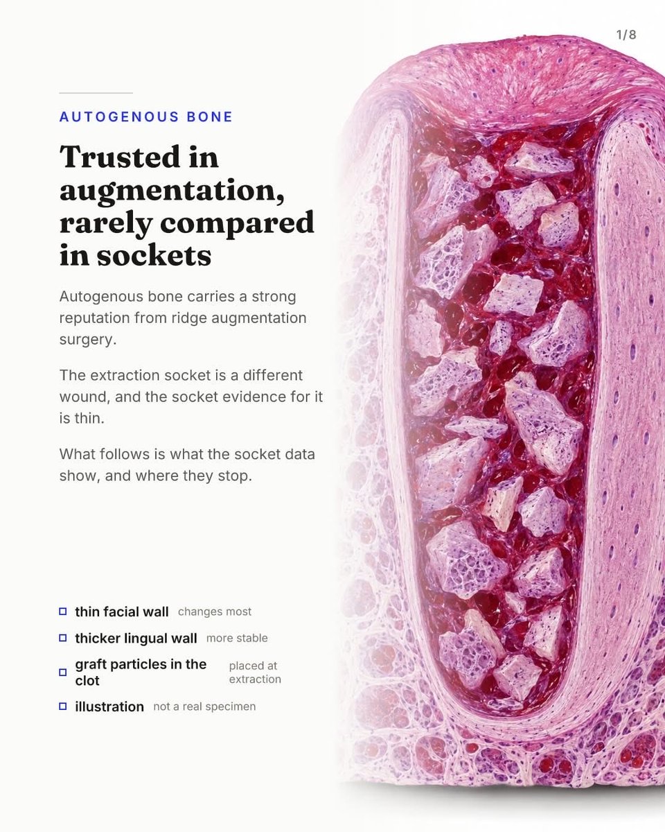 drAnasabdo's tweet photo. •Autogenous bone earns its reputation in ridge augmentation. Inside a fresh extraction socket, that reputation is mostly untested.
•الطعم الذاتي في الحفاظ على جوف القلع.
Courtesy:Advanced implantology work group

#endo_prostho_ortho
#EPO
#DrABDO
•You can ask …!!

•follow me: https://t.co/VLa3xRfhT5