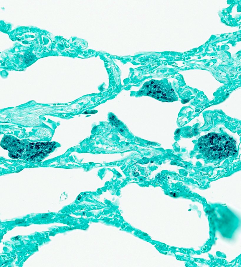 Saroja_DeviG's tweet photo. 🔬 Lung wedge resection: H&amp;E and GMS.

What’s your diagnosis?

Clue: Pink froth+ ping-pong balls 🧼🏓

#PathTwitter #MedTwitter #PulmPath #LungPath #USMLE #PathFellow #PathResidents https://t.co/RAAFlPivCx