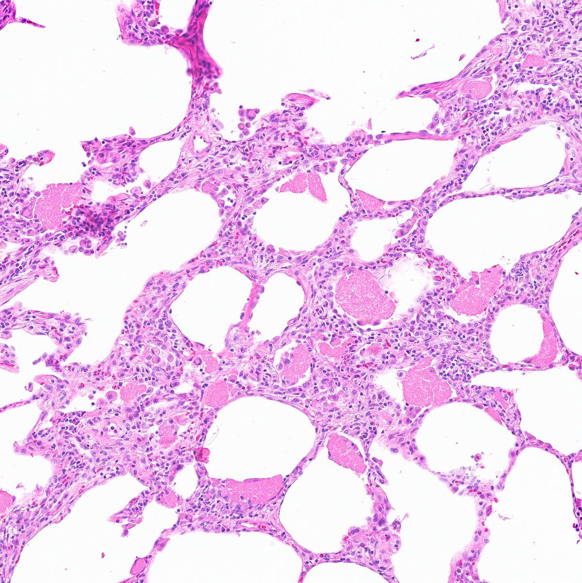 Saroja_DeviG's tweet photo. 🔬 Lung wedge resection: H&amp;E and GMS.

What’s your diagnosis?

Clue: Pink froth+ ping-pong balls 🧼🏓

#PathTwitter #MedTwitter #PulmPath #LungPath #USMLE #PathFellow #PathResidents https://t.co/RAAFlPivCx
