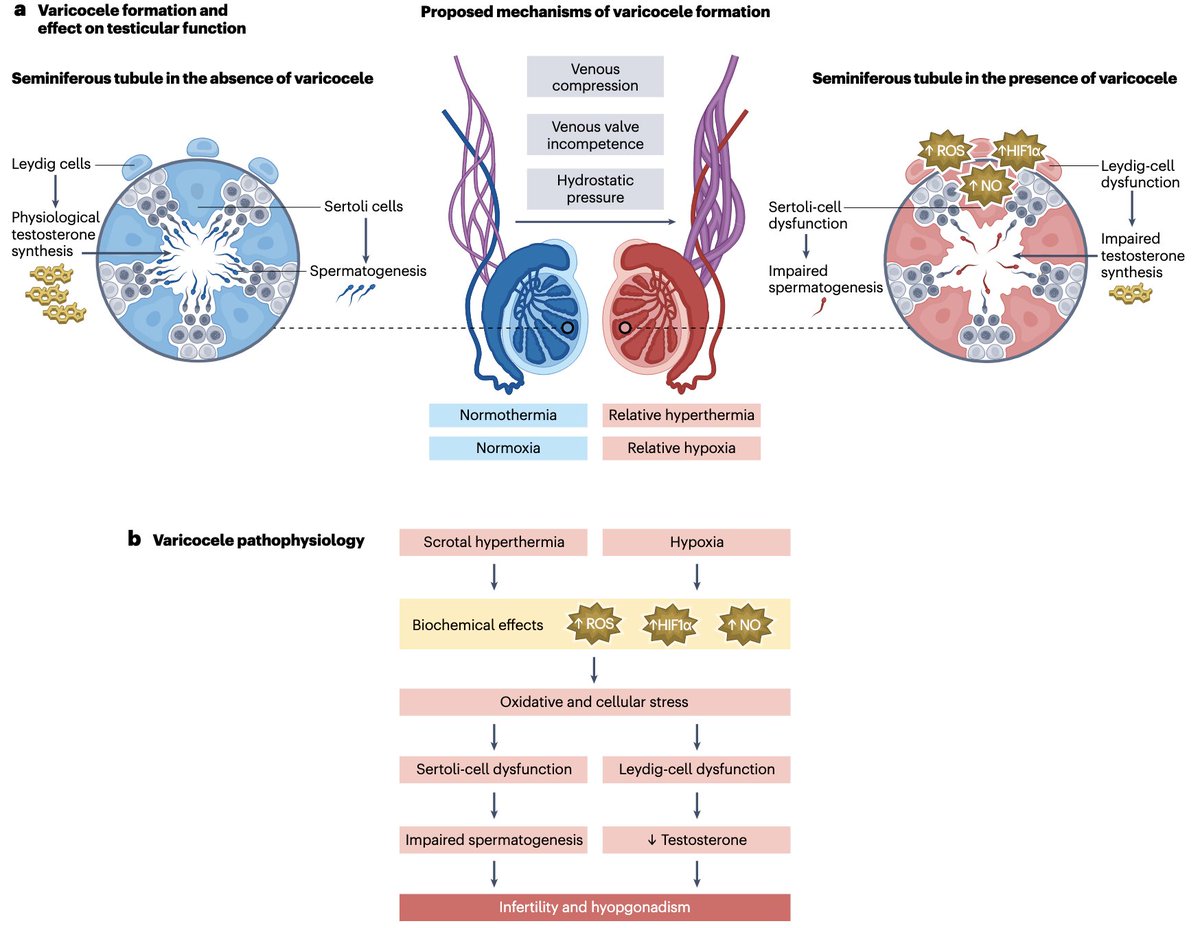 BlitzUro's tweet photo. Check out our @NatRevUrol review on observation or treatment of pediatric varicoceles. We provide a risk-stratification schema that can inform clinical decision-making. https://t.co/iNIr3jILJJ

@CleClinicUro @lynnlwoo @JHannickMD @ScottLundyMDPhD @jweave2925 https://t.co/64Rha1BoNR