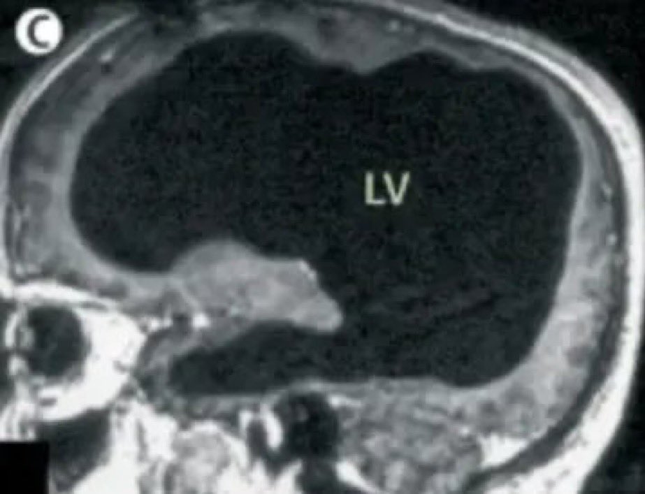 SciNatureNews's tweet photo. A man was discovered with almost 90% of his brain mass missing, while leading an almost normal life https://t.co/eO37b6wgmF