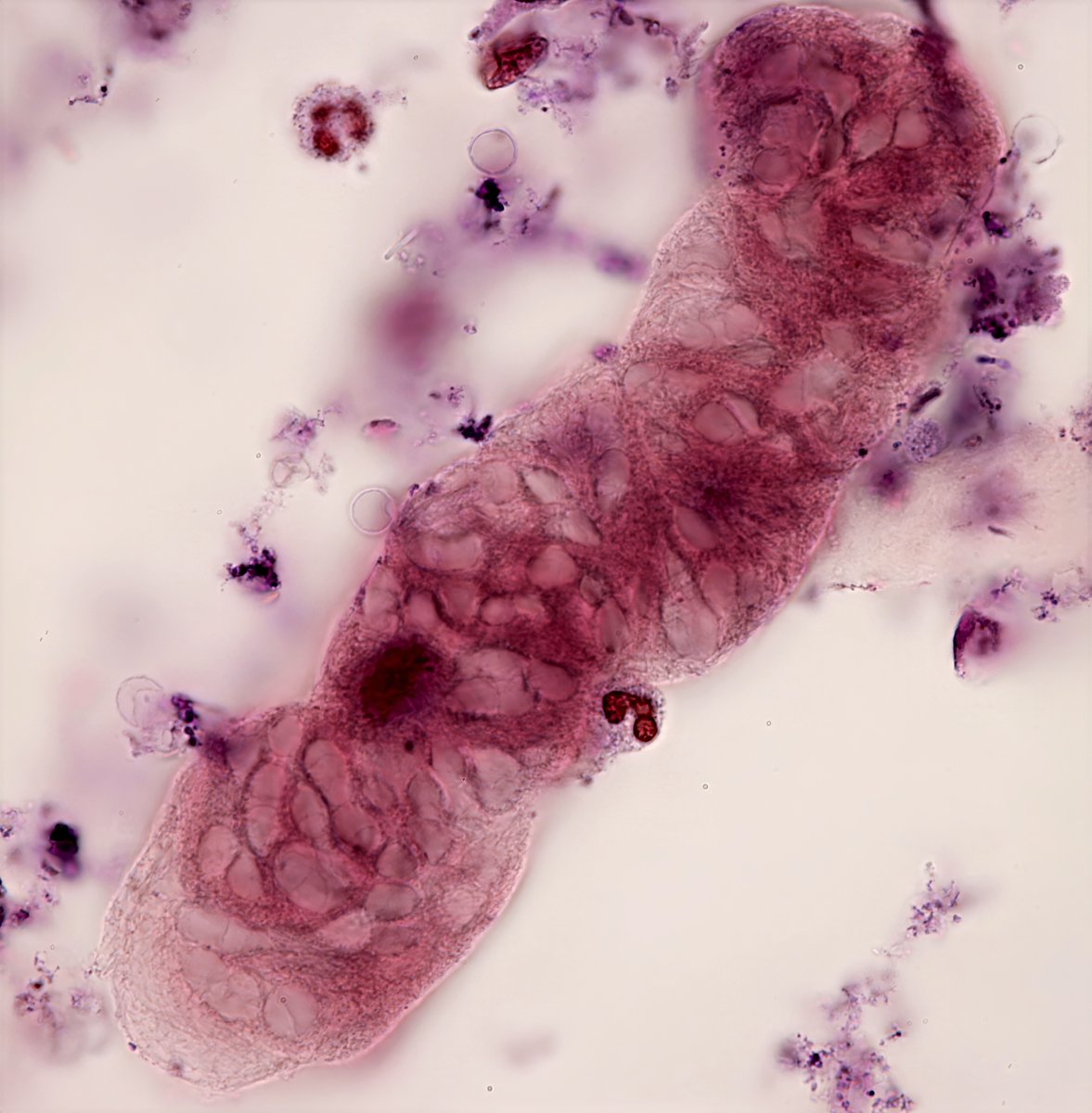 jrseltzer's tweet photo. Fibrin cast containing RBC's  - brightfield  with SM stain - from young woman presenting with acute respiratory failure, and AKI -  #UrinarySediment #UrineMicroscopy https://t.co/LfL8nst1gz