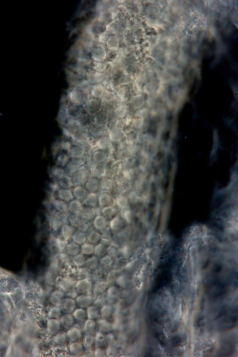 jrseltzer's tweet photo. RBC cast under darkfield illumination - from young woman presenting with acute respiratory failure, and AKI -  #UrinarySediment #UrineMicroscopy https://t.co/j9UgOphhlQ
