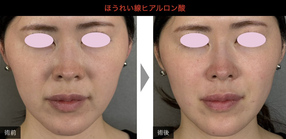 dr_egoh's tweet photo. 写真で拝見する限りですが、鼻横の影は、ほうれい線や鼻翼基部の凹みが原因になっている可能性があります。

この部分にヒアルロン酸を入れると、影が目立ちにくくなることがあります。
写真だけでの判断にはなるので、実際の適応は診察してみないとわからない部分もあります。

参考までに、鼻翼基部とほうれい線にヒアルロン酸を入れた症例を置いておきます。