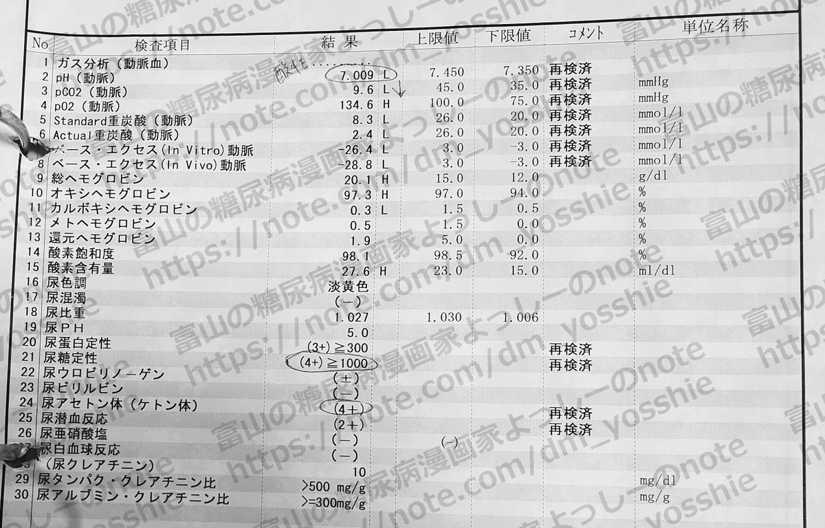 dmyosshie's tweet photo. 診断時にタンパク尿(3+)潜血(2+)だったのは糖尿病腎症のせいではなく糖尿病性ケトアシドーシスで脱水状態に陥っていたせいだと思う💦
#糖尿病 #糖尿病腎症 #DKA https://t.co/HVfA4CZMrF