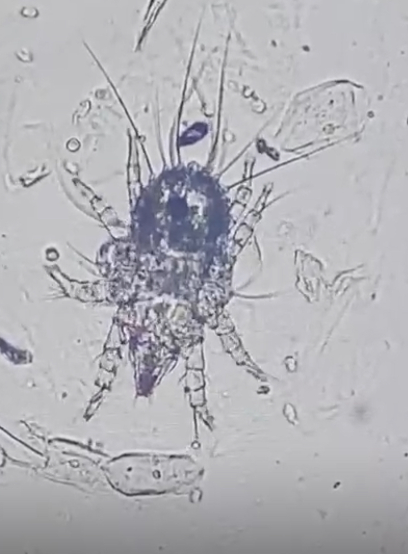ParasiteGal's tweet photo. The #Parasite Case 819 is up, donated by @VasuMicroCaucus: an arthropod found in a urine specimen from a woman living in rural India. What is your identification? https://t.co/PKzNN5nfSp
Answer later this week! #mayopath #pathology #PathBugs #CrittersOnTwitter https://t.co/FCvNgIId5T