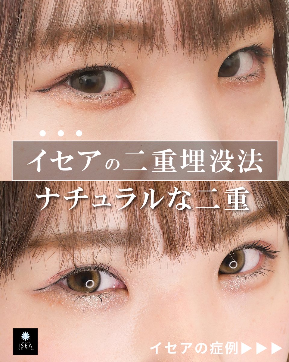 isea_case's tweet photo. 埋没法プレミアム 　#二重埋没法　
執刀医：大山　希里子

Before：術前
After：1か月後

■埋没法サイト
https://t.co/3XcAnoDIiX

■埋没法Instagram
https://t.co/cdoWtKtEoq

■大山 希里子Instagram
https://t.co/w4QfwSpMiN

■リスク
血腫・感染の可能性がある、腫れ、内出血、鈍痛

■料金
埋没法プレミアム　両目　198,000円(税込)
