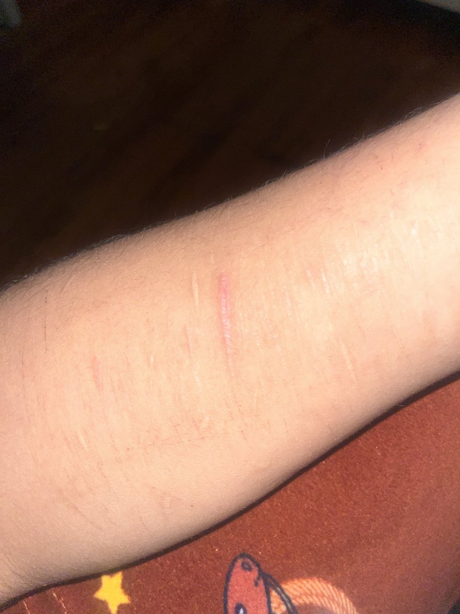 koenzei's tweet photo. ive been sh free for like 2 weeks but i kinda wanna relapse just for fun💀 plus my scars r lame #shedtwt #scartwt https://t.co/wrEBg0dzg6