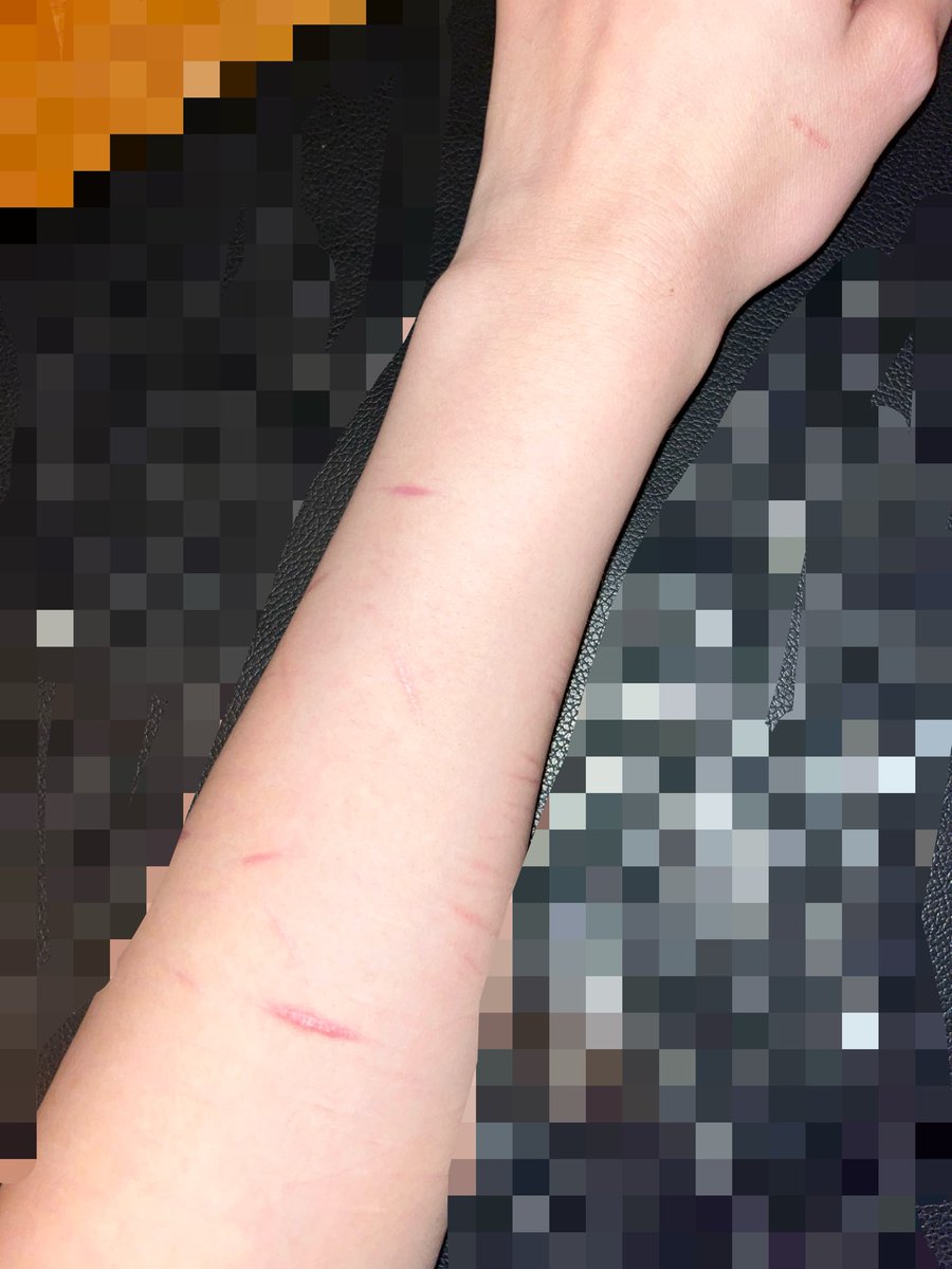 c1garettesinbed's tweet photo. slight scars on my bmi fatass arm
i haven’t cut in like 2 months cuz im lazy asfuck https://t.co/XECGJj5Jwd