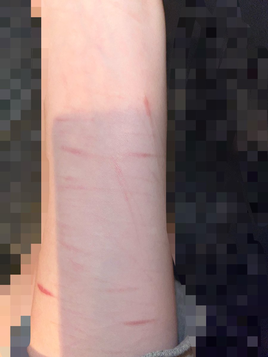 c1garettesinbed's tweet photo. slight scars on my bmi fatass arm
i haven’t cut in like 2 months cuz im lazy asfuck https://t.co/XECGJj5Jwd