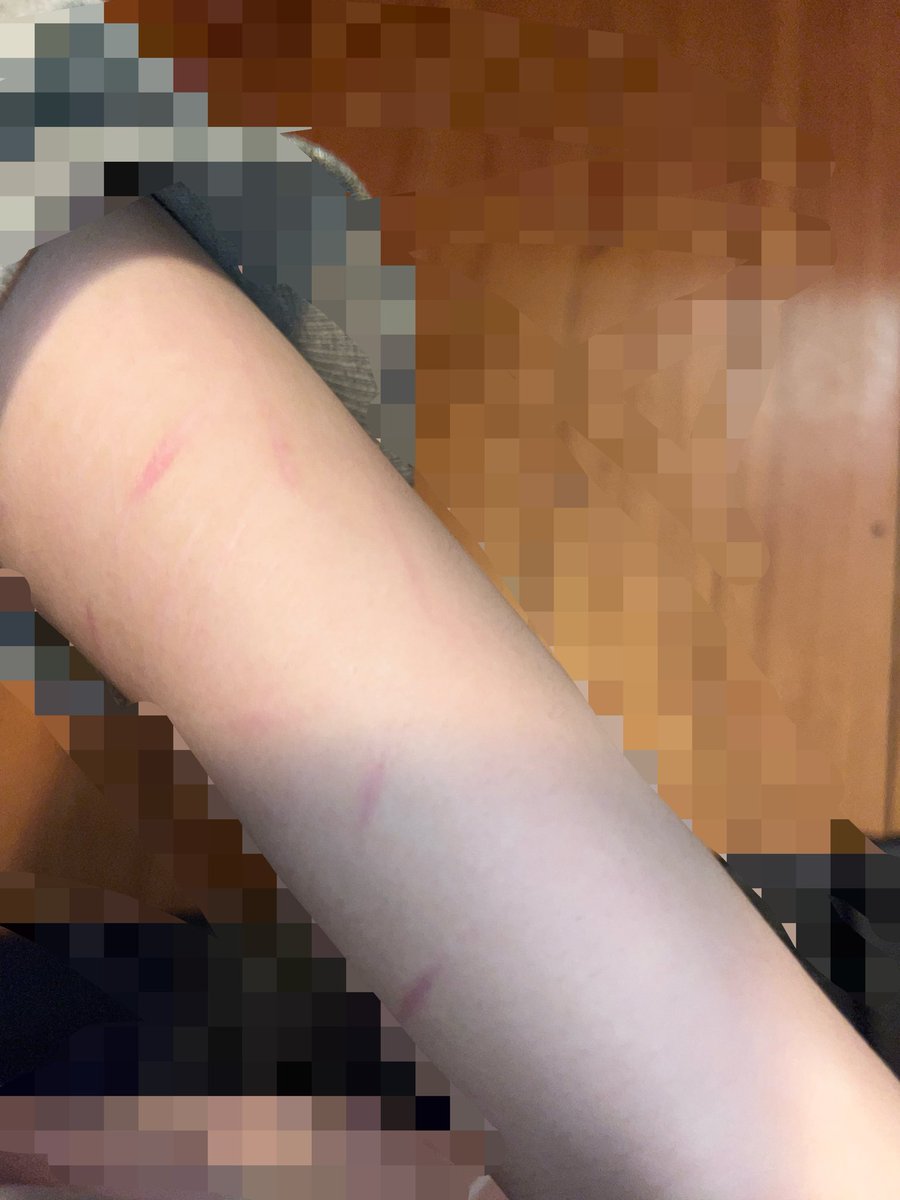 c1garettesinbed's tweet photo. slight scars on my bmi fatass arm
i haven’t cut in like 2 months cuz im lazy asfuck https://t.co/XECGJj5Jwd