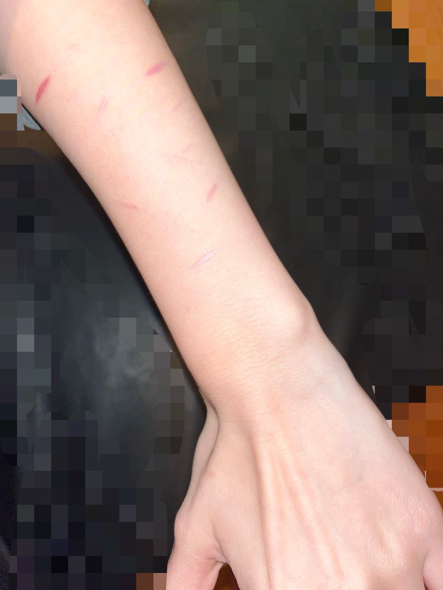 c1garettesinbed's tweet photo. slight scars on my bmi fatass arm
i haven’t cut in like 2 months cuz im lazy asfuck https://t.co/XECGJj5Jwd